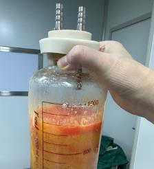 宜昌水动力吸脂手术要做多久？